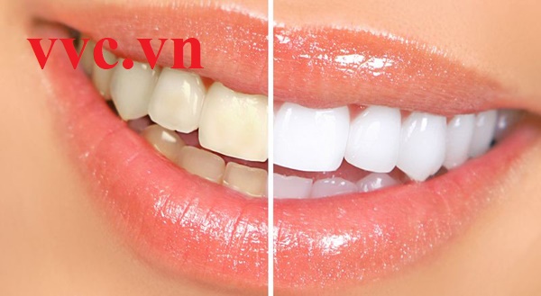Mẹo làm trắng răng hiệu quả tại nhà mà bạn không nên bỏ qua